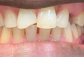 Stratford Family Dental | Night Guards, Periodontal Treatment and Veneers