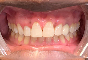 Stratford Family Dental | Invisalign reg , Implant Dentistry and Teeth Whitening