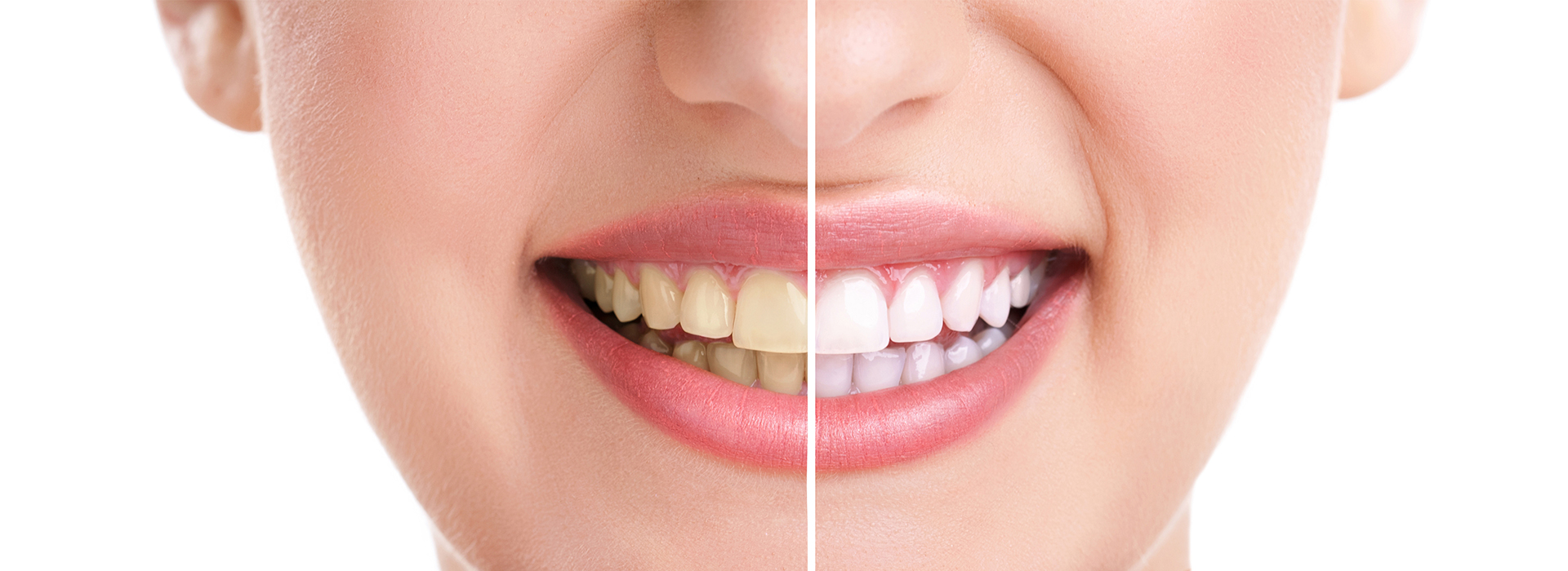 The image shows a close-up of a smiling person with a crooked tooth, likely for dental treatment advertisement purposes.