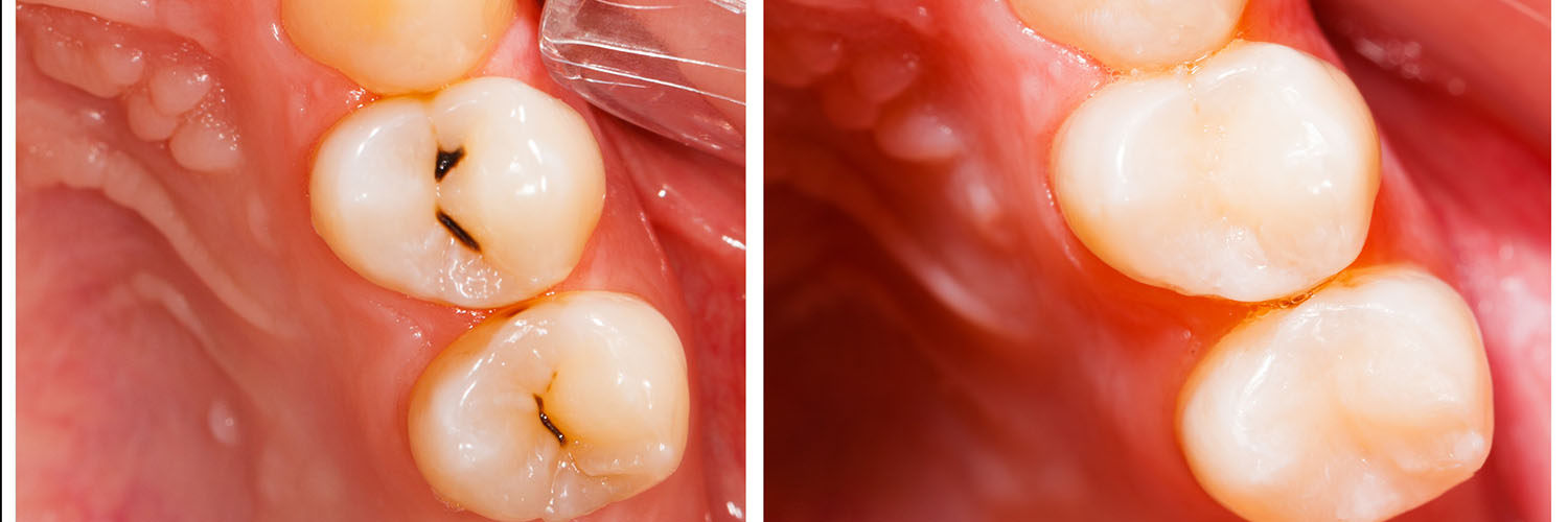 The image shows a close-up view of a person s mouth with teeth, featuring two large front teeth with visible cavities and fillings, and a partial view of the tongue at the bottom.