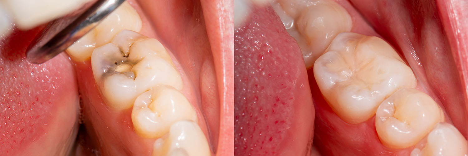 The image shows a close-up view of a person s teeth with food particles lodged between them, emphasizing dental hygiene concerns.