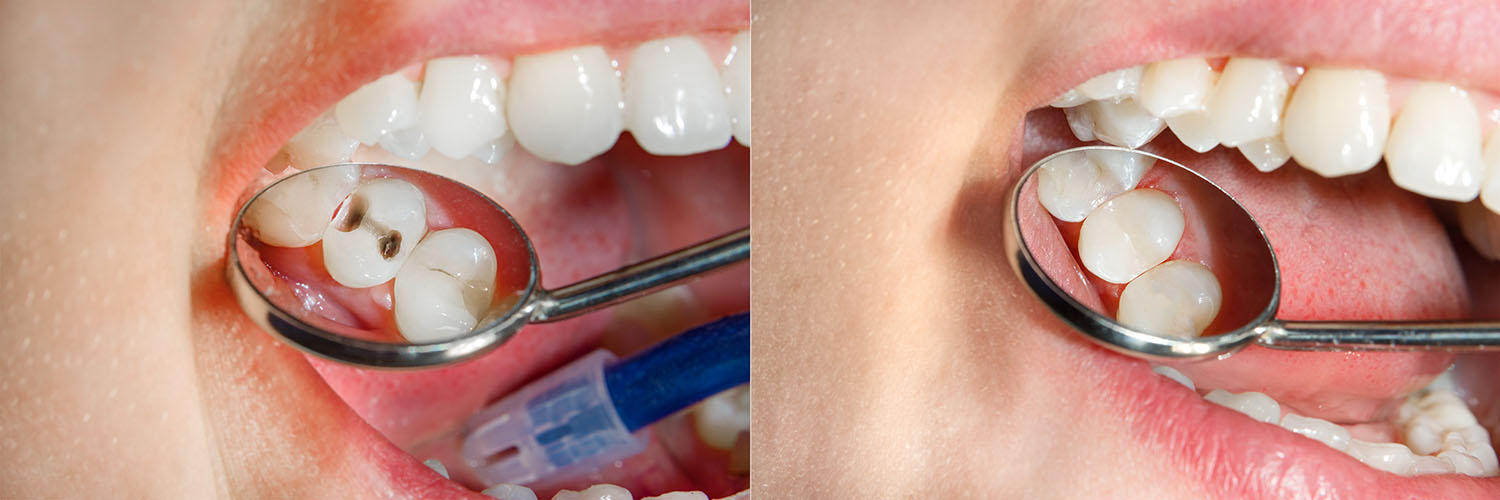 The image shows a person with a large gap between their front teeth, holding an object resembling a magnifying glass over their mouth, which appears to be a close-up of the same person s open mouth revealing a dental implant.